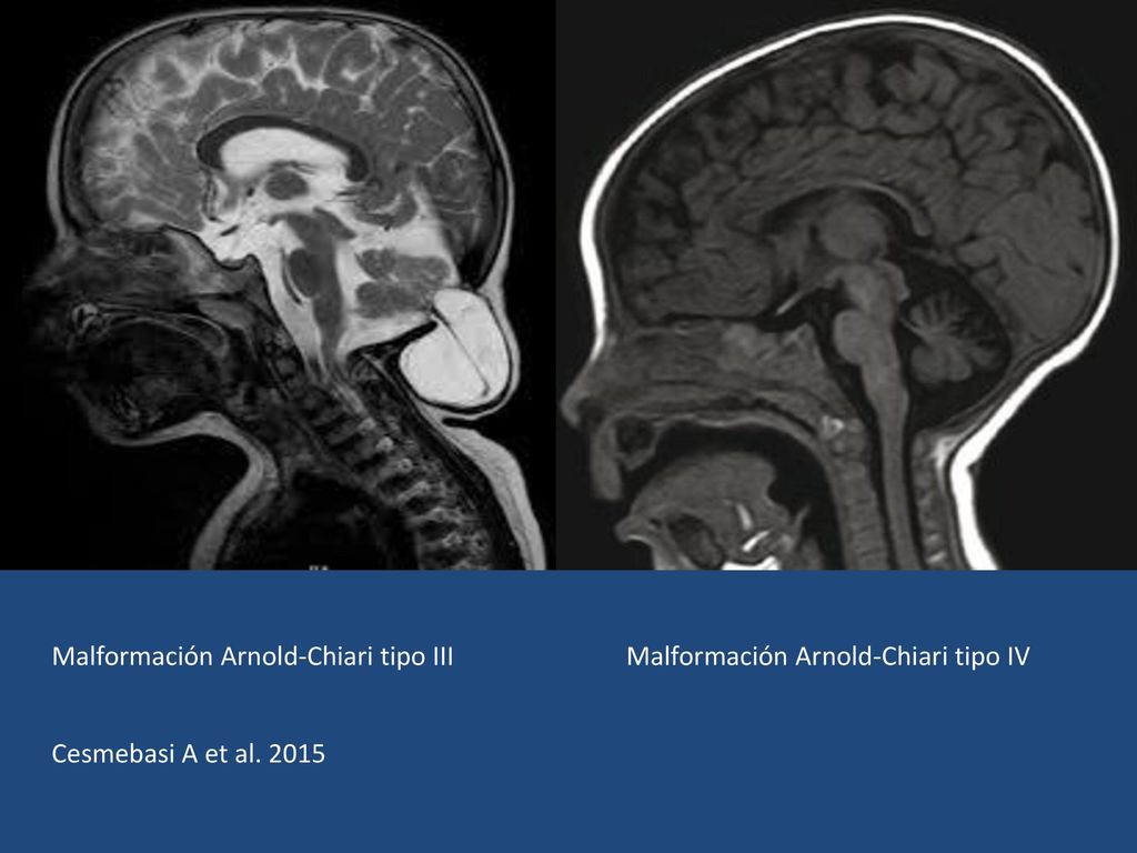 malformacion de arnold chiari tipo 1
